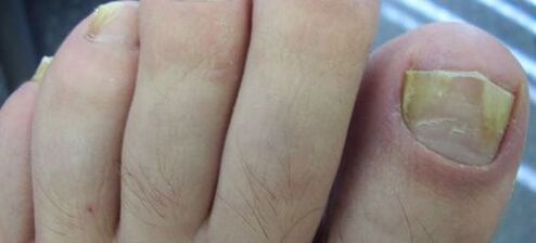 síntomas de hongos en las uñas y su tratamiento con vinagre