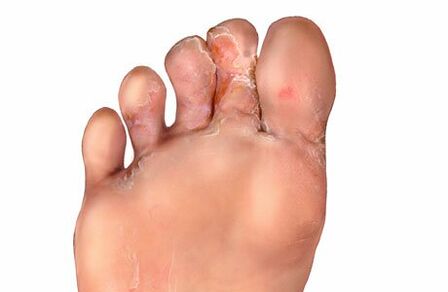 síntomas de hongos en los dedos de los pies