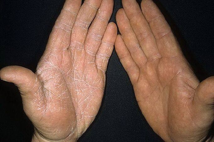 síntomas de un hongo en la piel de las manos