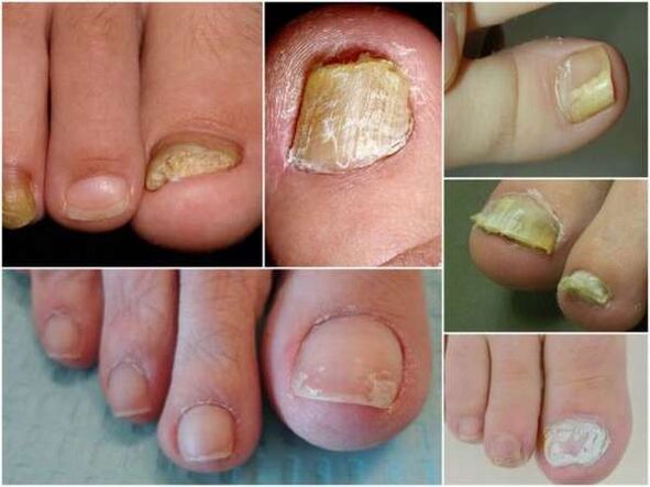 formas de hongos en los dedos del pie