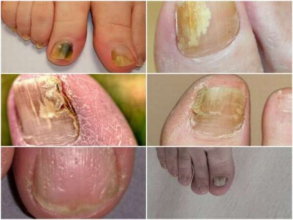 signos de hongos en las uñas de los pies