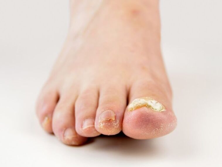 uñas de los pies afectadas por hongos