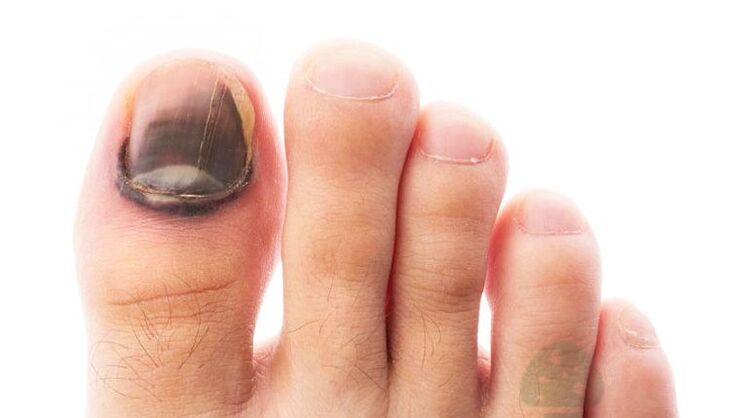 etapa avanzada de la enfermedad con un hongo en la uña del pie grande