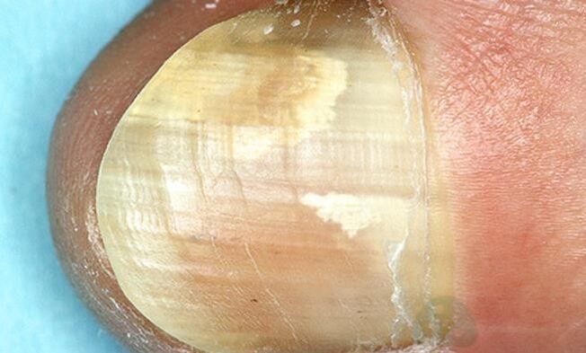 tratamiento de hongos en las uñas de los pies con preparaciones internas
