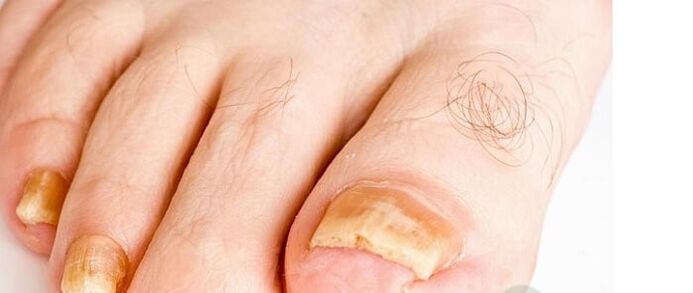 variedades de hongos en las uñas de los pies