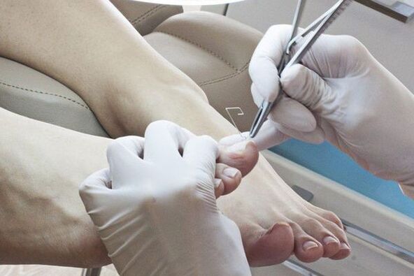 Eliminación mecánica de las uñas de los pies afectadas por hongos. 