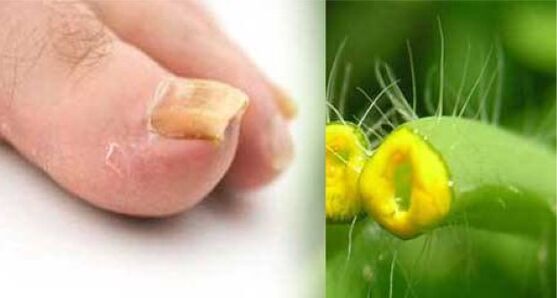 hierba celidonia para hongos en las uñas de los pies