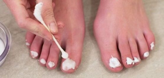 tratamiento de hongos en las uñas de los pies con ungüento