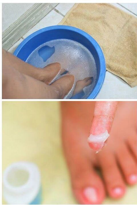 el uso de aceites naturales en el tratamiento de hongos en las uñas de los pies