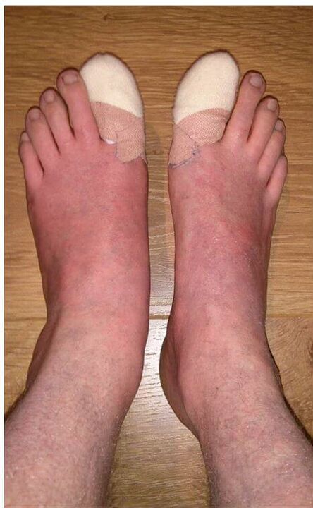eliminación de las uñas de los pies afectadas por hongos