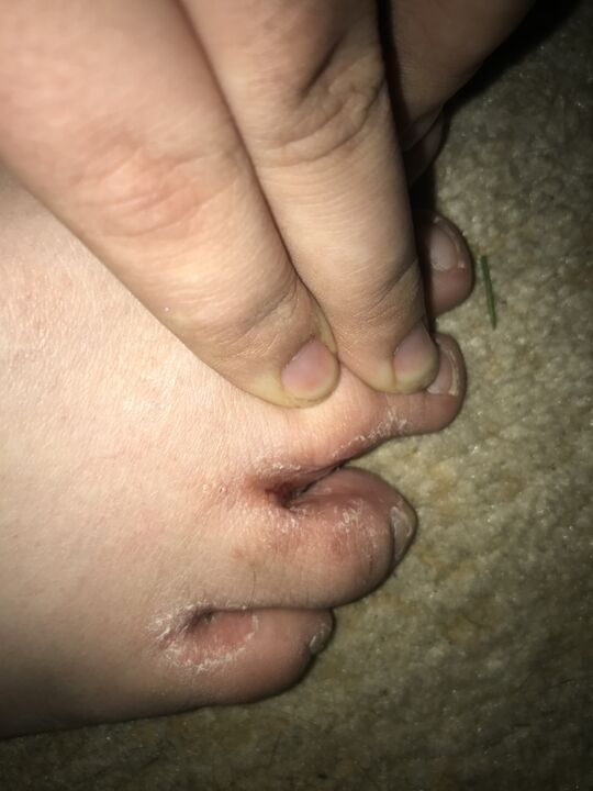 infección por hongos en el dedo del pie