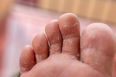 síntomas de infecciones fúngicas de los dedos de los pies
