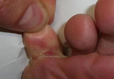 una grieta en el dedo del pie es el resultado de una infección por hongos